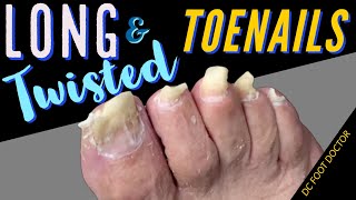 Long and Twisted Toenails Trimming Long Toenails [upl. by Sallie515]