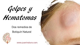 Dos recursos naturales contra golpes y hematomas [upl. by Sudnak]