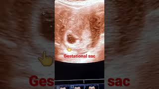 Gestational sac was found in early pregnancy [upl. by Nyletac707]