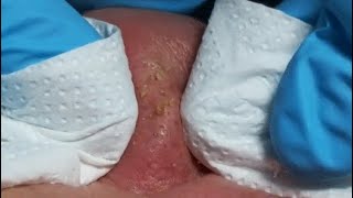 ENJOY YOUR DAY WITH JOSEFA REINA relaxing blackheads [upl. by Eibo]