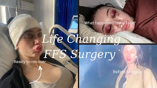 My FFS Experience Journey Surgery Day Recovery and Results [upl. by Jem]