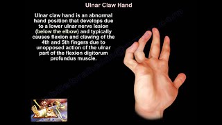 Claw Hand and Ulnar Claw Hand  Everything You Need To Know  Dr Nabil Ebraheim [upl. by Antonetta796]