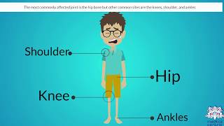 OSTEONECROSIS Causes Signs and Symptoms Diagnosis and Treatment [upl. by Anairdna]