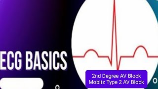 ECG Basics  Second Degree Mobitz type 2 Heart Block  Hay Block Causes of Mobitz II AV Block [upl. by Tatman]