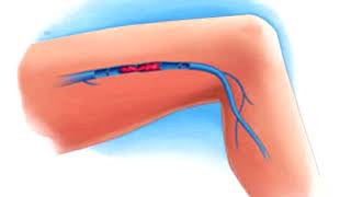 Symptômes d’une thrombose veineuse dans les jambes [upl. by Davies516]