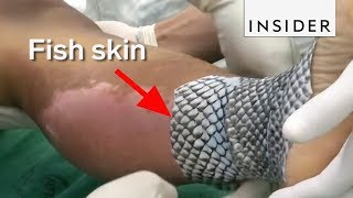 Doctors Are Using Fish Skin to Treat Burns [upl. by Katti]