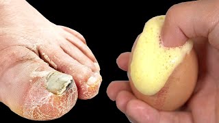 Cure Toenail Fungus For Less Than 1 in under 1 minute You must do it [upl. by Esilana]