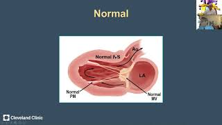 Hypertrophic Cardiomyopathy Anatomic Variants and Echocardiographic Pearls from Dr Harry Lever [upl. by Ennaej109]