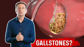 What is a Gallbladder Attack – Symptoms amp Causes Covered by DrBerg [upl. by Isador788]