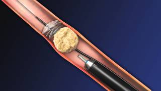 CoAx 10mm Stone Control Catheter from Accordion Medical [upl. by Thorstein]