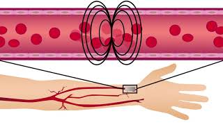 A new method for tracking endothelial dysfunction and heart disease risk in patients with diabetes [upl. by Llehcor699]