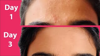 ACNE Treatment At Home  3 day Acne REMOVAL Challenge  Acne Treatment Ayurvedic with Results [upl. by Sevart591]