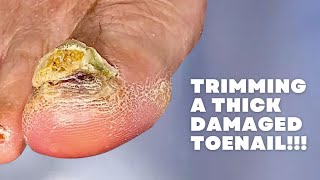 Trimming a THICK DAMAGED Toenail [upl. by Demaria]