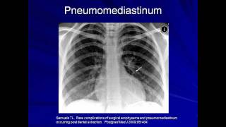 Lung Protective Ventilation Mechanical Ventilation  Lecture 9 [upl. by Ornie222]