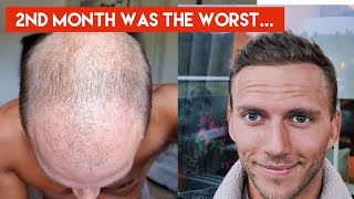 My Hair Transplant Journey  The AWFUL first 4 months indepth walkthrough week by week [upl. by Salkcin]