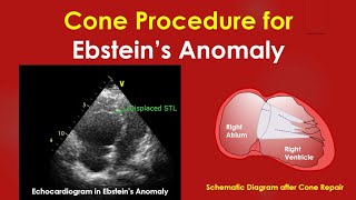 Cone Procedure for Ebstein’s Anomaly [upl. by Htnamas]