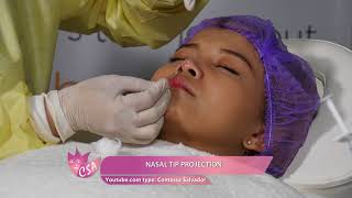 NON SURGICAL NOSE  NASAL TIP PROJECTION [upl. by Nyltac450]