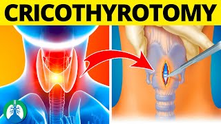 Cricothyrotomy Medical Definition  Quick Explainer Video [upl. by Eittocs]