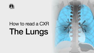 How to Read a Chest XRay The Lungs [upl. by Enneyehs491]