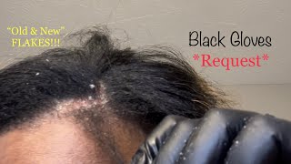 Dandruff Removal Dandruff Scratching Big Patch of Flakes amp Scabs off Scalp  Scalp Psoriasis [upl. by Nnyleve]