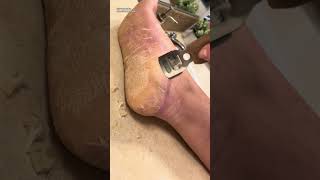 EXTREME CALLUS Shaving Removal ASMR Pedicure  Hyperkeratosis EPPK Foot  Nov 10 2023 [upl. by Eitnom613]