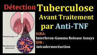 Dépistage de Tuberculose latent avant AntiTNF infection tuberculeuse pulmonaire IDR interféron Gamma [upl. by Dnomaj]