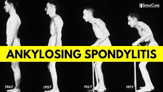 What is Ankylosing Spondylitis Causes Symptoms and Diagnosis EXPLAINED [upl. by Red]