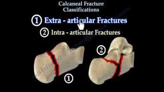 Calcaneal Fracture Classifications  Everything You Need To Know  Dr Nabil Ebraheim [upl. by Llennaj798]