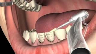 What are Dental Veneers [upl. by Arriaet975]