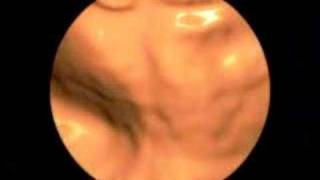 3D Medical Animation of a Colonoscopy [upl. by Anirtep161]