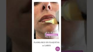 Plasma Rico en Plaquetas en Labios ¿Querés Ver Cómo es Bienvenidos a Biozone Medicina Estética [upl. by Karas63]