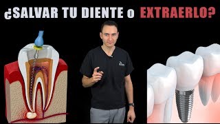 ENDODONCIAS VS IMPLANTES  ¿Es mejor salvar tu diente o extraerlo  Costos 2019 [upl. by Anemix]