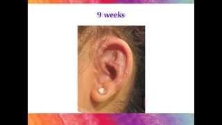 Microtia Ear Surgery  The Healing Process with the Porous Implant Ear Reconstruction technique [upl. by Ahsenwahs238]