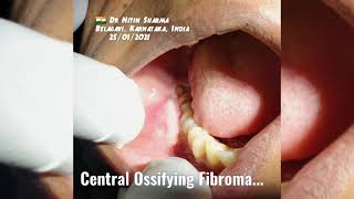 Central Ossifying Fibroma [upl. by Dix]