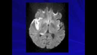 Aseptic Meningitis  Ana Velez MD [upl. by Ramaj]