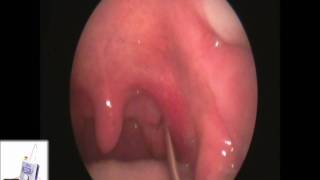 Tonsil Stone Extraction with Laser Cryptolysis [upl. by Bradly]