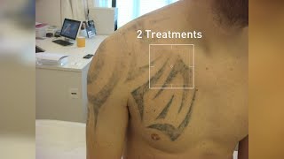 PicoSure Laser TattooRemoval  Before and afters  Zapp Laser Studio [upl. by Val]