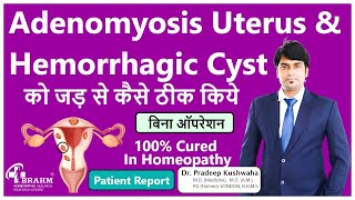 HEMORRHAGIC OVARIAN CYST Treatment  ओवेरियन सिस्ट क्या है  महिलाओं के अंडाशय में सिस्ट  ovarian [upl. by Mandelbaum]