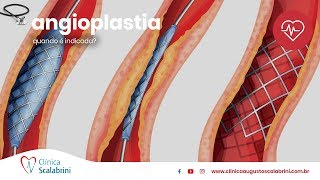 Quando é Indicada a Angioplastia [upl. by Cuthbert704]