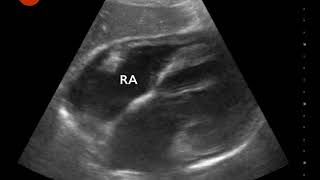 Video 3 Subxiphoid view demonstrating pericardial effusion with diastolic collapse [upl. by Nugent]