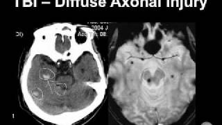 Diagnosing Brain Hemorrhages [upl. by Fortunato]