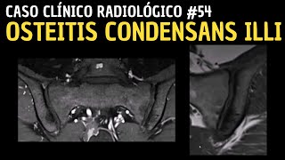 Caso Clínico Radiológico 54 Osteitis Condensans Illi [upl. by Enileuqkcaj310]