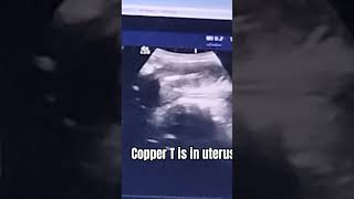 copper T is in uterus [upl. by Ahsienel]