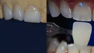 Full Shape HT Zirconia Veneers [upl. by Teerell963]