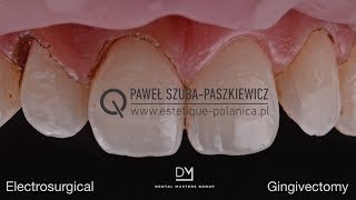 Electrosurgical Gingivectomy  Crown Lengthening [upl. by Ennywg388]