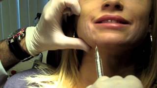 Cannula Method for Fillers  Dr Nissan Pilest Irvine CA [upl. by Yolande884]