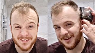 BALDING RECEDING Hairline 0 Buzz Cut Transformation At 24 [upl. by Garrik676]