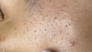 Satisfying Relaxing with Sac Dep Spa Video 087 acne [upl. by Diad388]