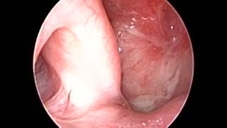 Nasopharyngeal Carcinoma SCC 10 years Follow up after Radiotherapy amp Chemotherapy [upl. by Pelligrini624]