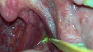 Tonsil Stone Removal By Yourself [upl. by Tletski]